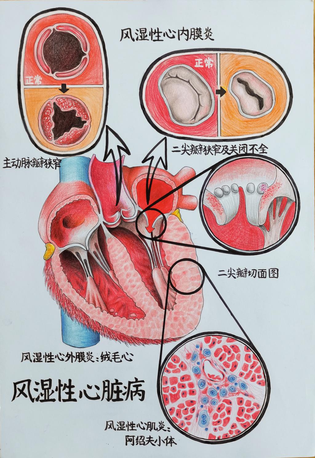 2. 邮寄手绘 作品分类 2 风湿性心脏病 xvideo
张晨彤